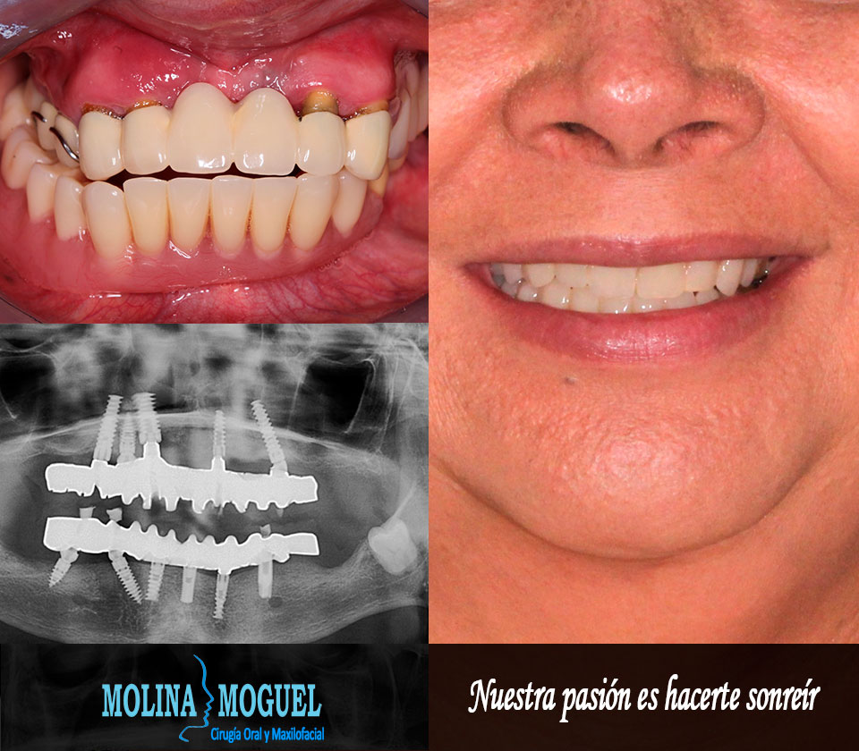 Dental cdmx implante costo