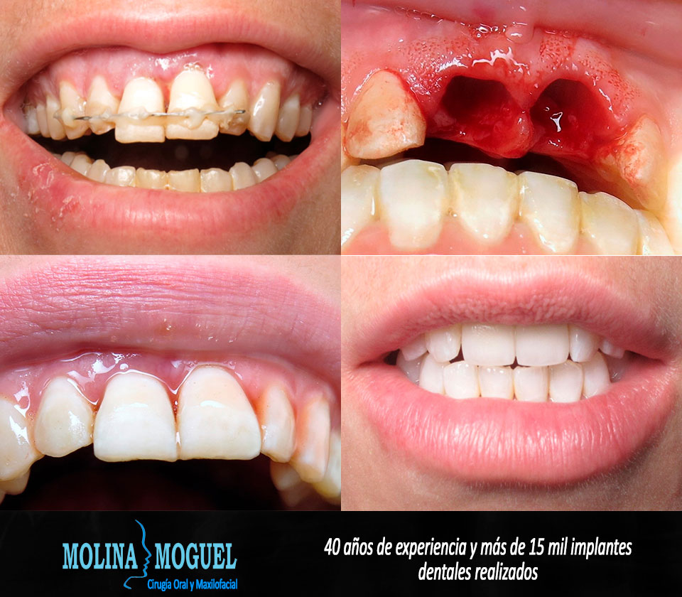 Dental cdmx implante costo