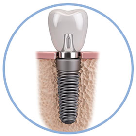 Implantes Dentales - Características