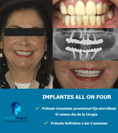 Implantes Dentales Caso Clínico