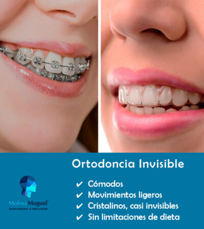 Ortodoncia Invisible
