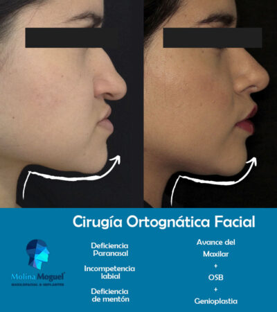 Cirugía Avance de Mentón