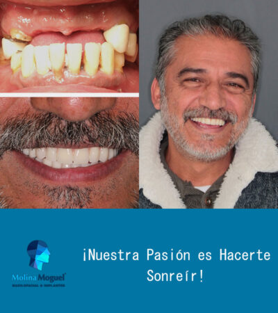 Implantes Dentales Antes y Después