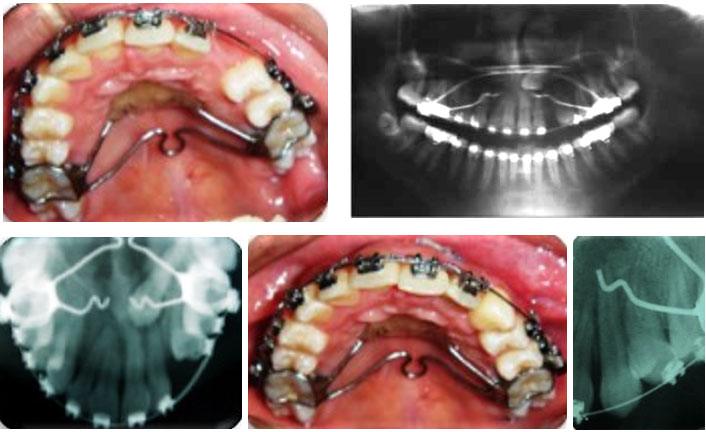 Autotrasplante Dental de Canino