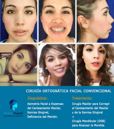 Cirugía Ortognática - Asimetría Facial