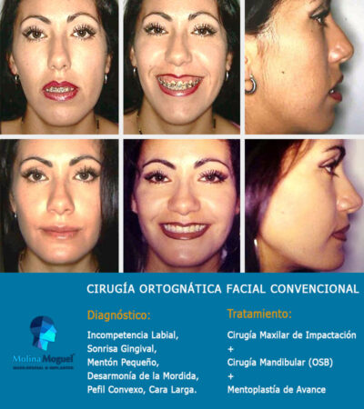 Cirugía Ortognática - Sonrisa Gingival