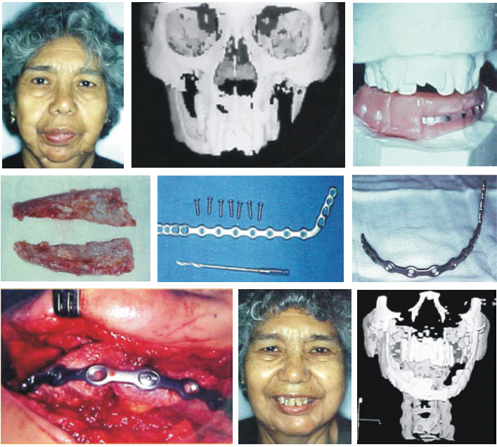 Linfoma no Hodgkin Intraóseo