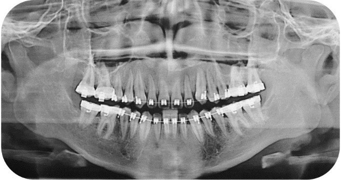 Ortodoncia Acelerada RX