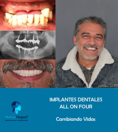 Implantes Dentales All on Four Caso Clínico