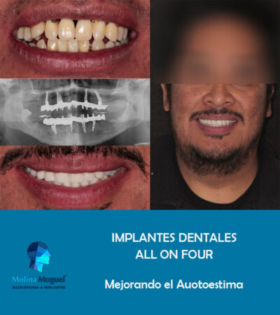 Implantes Dentales All on Four Caso Clínico