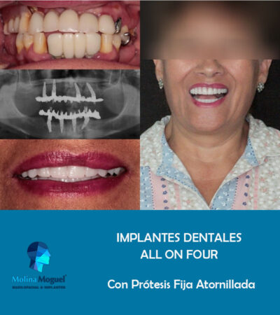 Implantes Dentales All on Four Caso Clínico