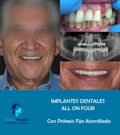 Implantes Dentales All on Four Caso Clínico
