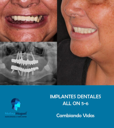 Implantes Dentales All on Four Caso Clínico