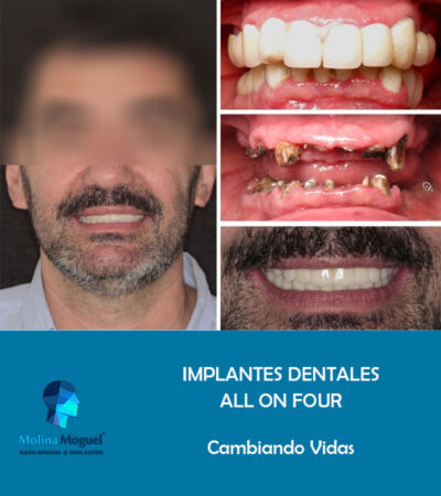 Implantes Dentales All on Four Caso Clínico