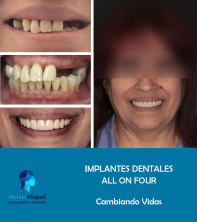 Implantes Dentales All on Four Caso Clínico