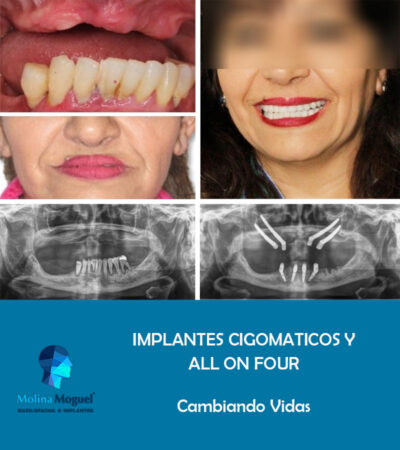 Implantes Dentales Caso Clínico