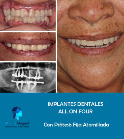 Implantes Dentales All on Four Caso Clínico