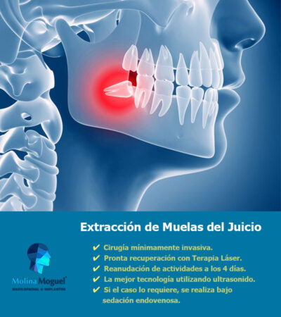 Extracción de Terceros Molares