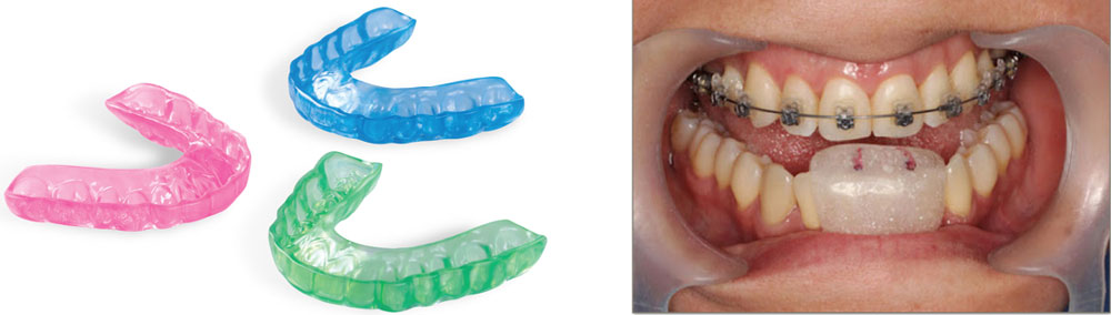 Dolor Facial Idiopático