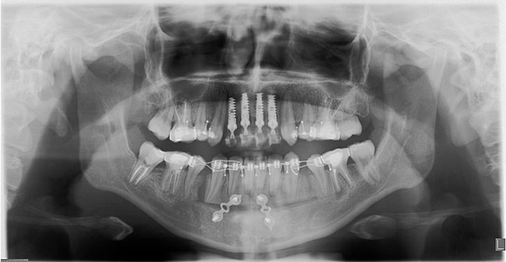 Caso Clínico con tratamiento integral