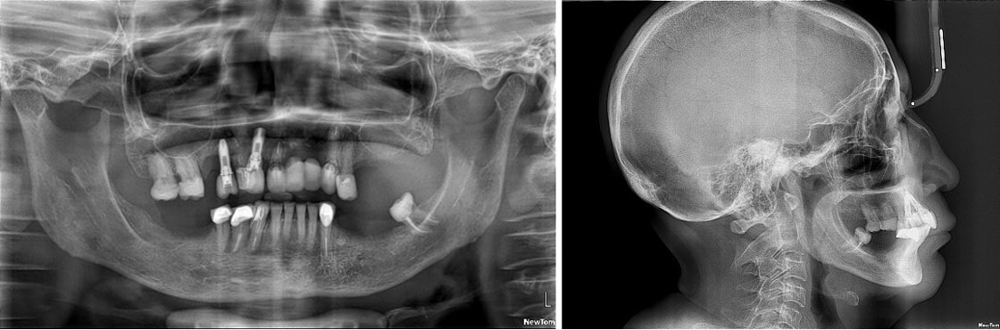 Implantes Dentales y Planeación 3D