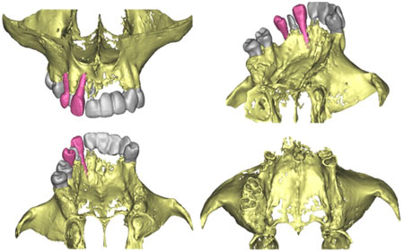 Implantes Dentales y Planeación 3D