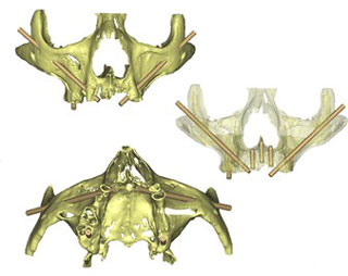 Implantes Dentales y Planeación 3D