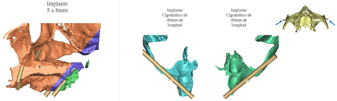 Implantes Dentales y Planeación 3D