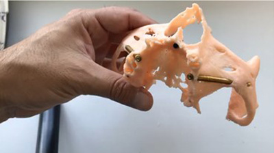 Implantes Dentales y Planeación 3D