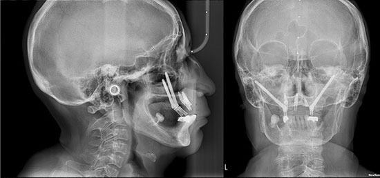 Implantes Dentales y Planeación 3D