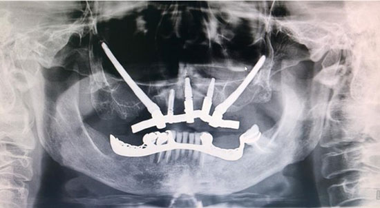 Implantes Dentales y Planeación 3D