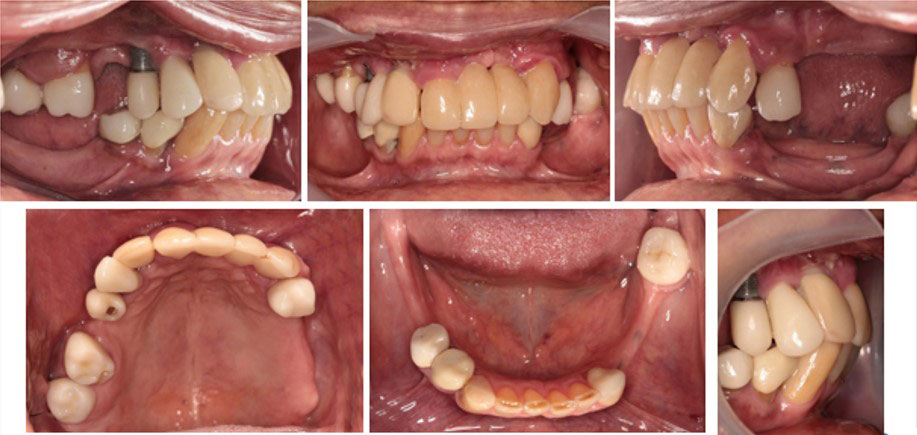 Implantes Dentales y Planeación 3D