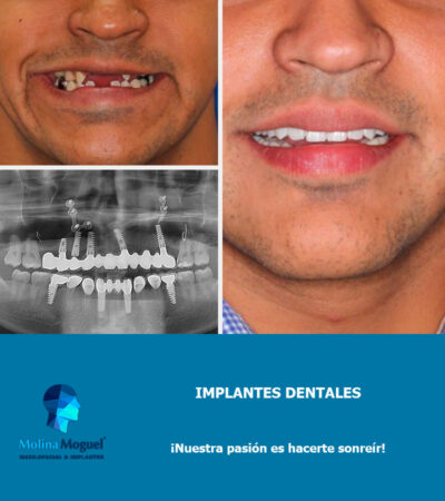 Implantes Dentales Caso Clínico