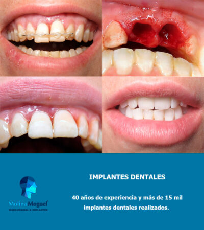 Implantes Dentales Caso Clínico