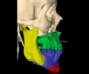 Digital Flow to obtain Surgical Guides