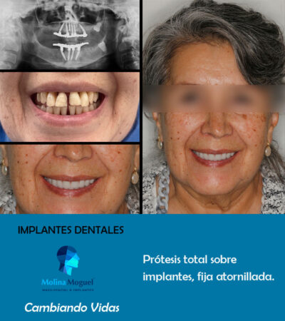 Implantes dentales All on Four - Caso Clínico