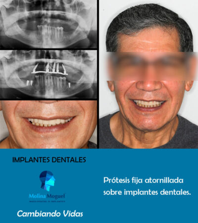Implantes dentales All on Four - Caso Clínico
