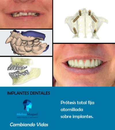 Implantes dentales All on Four - Caso Clínico