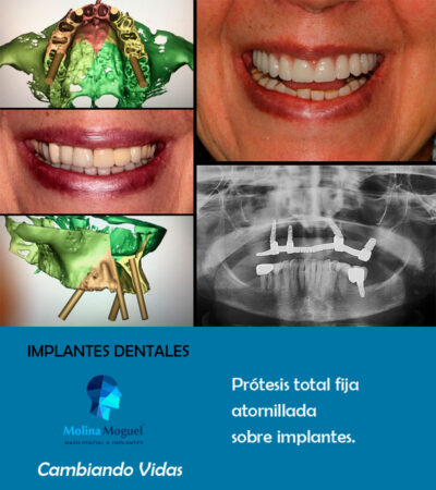 Implantes dentales All on Four - Caso Clínico