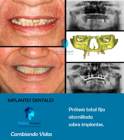 Implantes dentales All on Six - Caso Clínico
