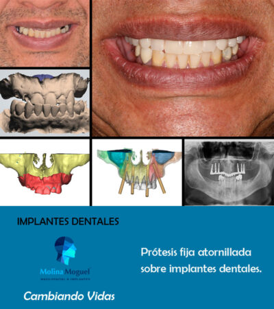Implantes dentales All on Six - Caso Clínico
