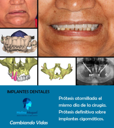 Implantes dentales Cigomáticos - Caso Clínico