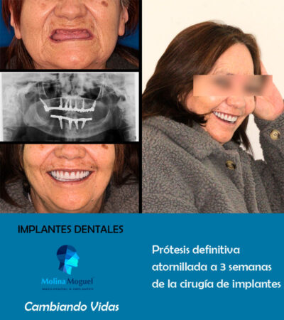 Implantes dentales Prótesis Completa - Caso Clínico