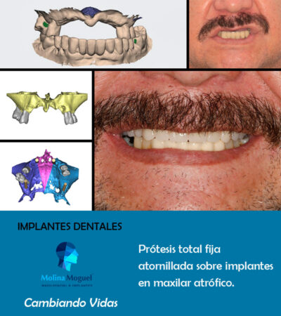 Implantes dentales Prótesis Completa - Caso Clínico