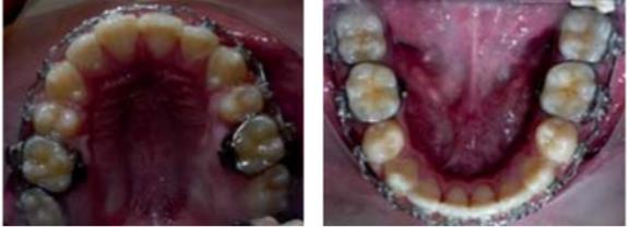 Maloclusión tratamiento Ortodoncico