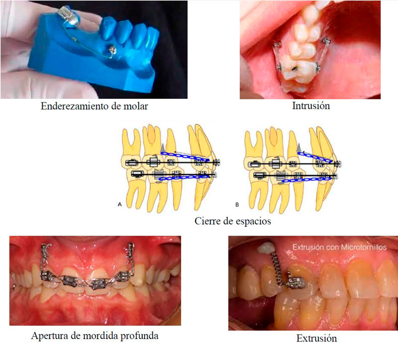 Ortodoncia con el uso de microimplantes