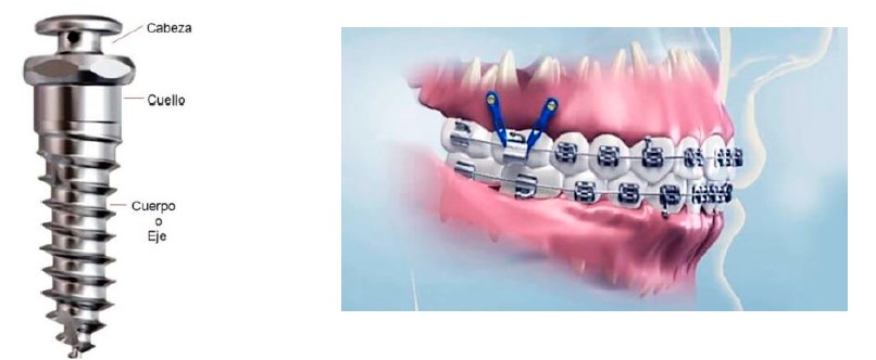 Ortodoncia con el uso de microimplantes