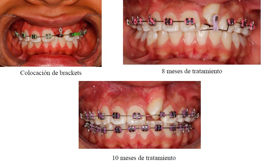 Tratamiento ortodóncico de caninos retenidos