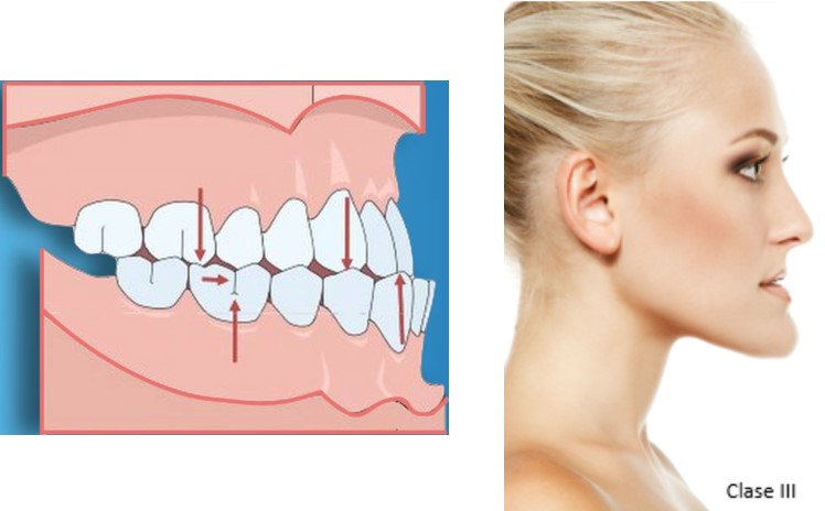 Maloclusión Clase 3