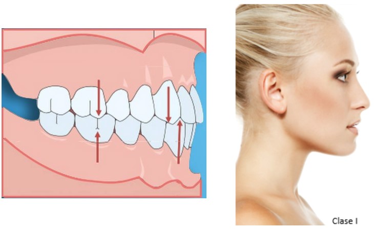 Maloclusión Clase 1